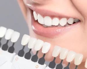 How long does tooth bonding last